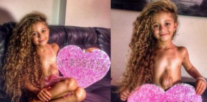 Kisah Virsaviya: Anak yang Bertahan Hidup dengan Jantung di Luar Dada