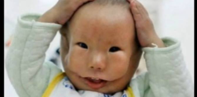 Ibu ini Menangis Melihat Bayinya Lahir dengan Wajah Seperti Topeng