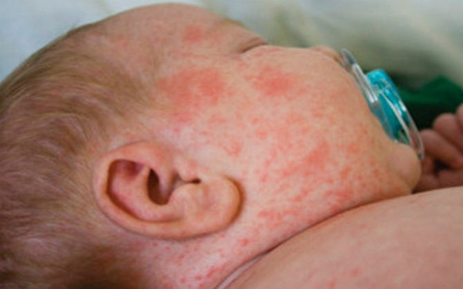 Hal Penting Seputar Virus Campak yang diderita oleh Bayi hingga Orang Dewasa