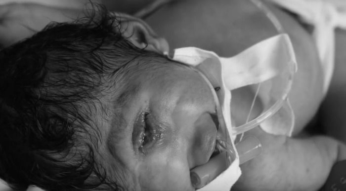 Yang Harus Dilakukan Jika Bayi Lahir dengan Cacat Lahir (Birth Defect)