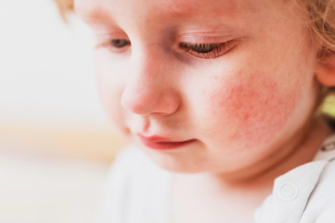 Roseola infantum