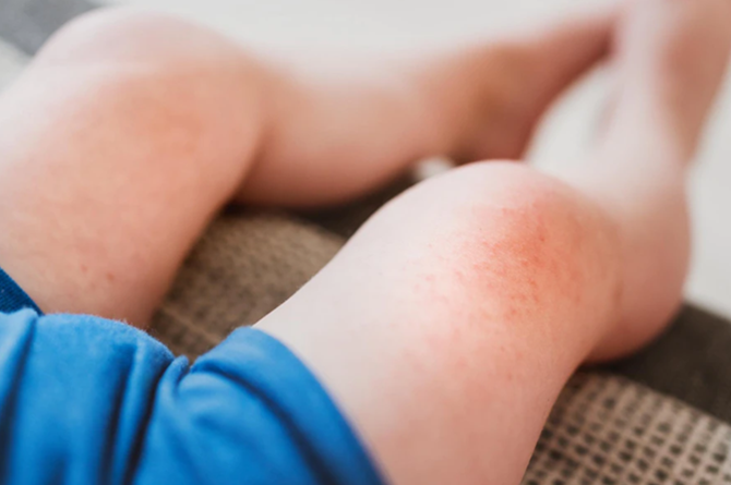 Roseola Infantum in Babies: Symptoms, Causes, How to Treat