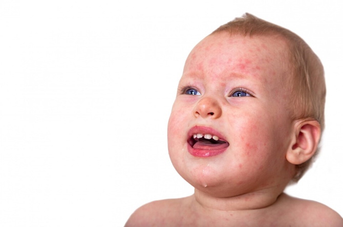 Roseola infantum