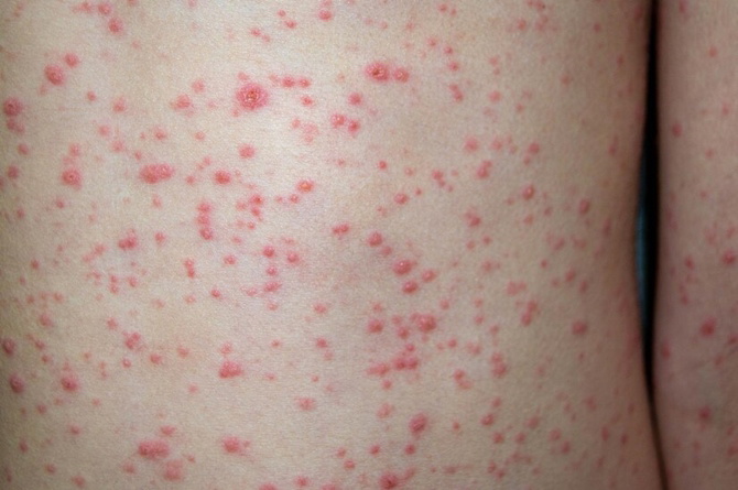 Roseola infantum