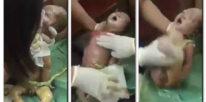 5 Menit yang Mendebarkan! Lihat Usaha Bidan Menghidupkan Kembali Bayi yang Terlahir Mati