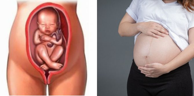 Apa Penyebab Bayi Sungsang? Ini Faktor Risiko dan Cara Menanganinya