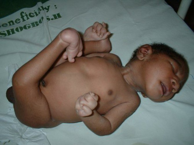 Edwards Syndrome, Kelainan Genetis yang Menyebabkan Bayi Cacat Lahir atau Stillborn