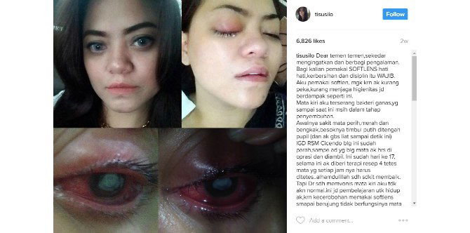 Mata Buta Sebelah, Wanita Asal Bandung ini Memperingatkan Bahaya Memakai Lensa Kontak