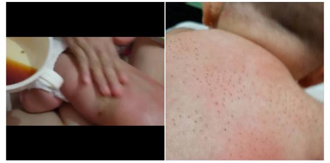 Soal Kulit Bayi yang Mengeluarkan Duri Setelah dipijat, Ini Kata Ibu yang Mempraktikkannya