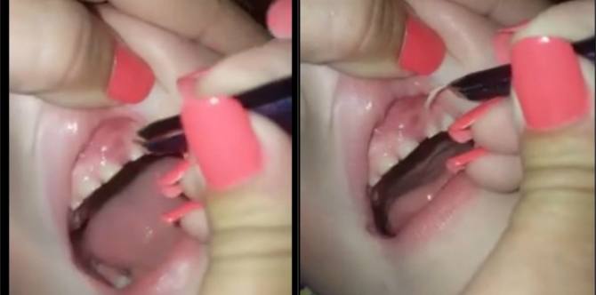 Bahaya Kebiasaan Menggigit Kuku; Anak ini Memasukkan 32 Potongan Kuku ke dalam Gusinya