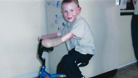 Kisah Anak Kupu-Kupu: Tidak Menyerah Meski Menderita Penyakit Kulit Langka