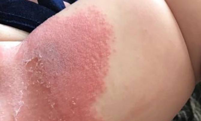 Bayi ini Terkena Ruam Parah Karena Popok Murah, Peringatan Bagi Orangtua