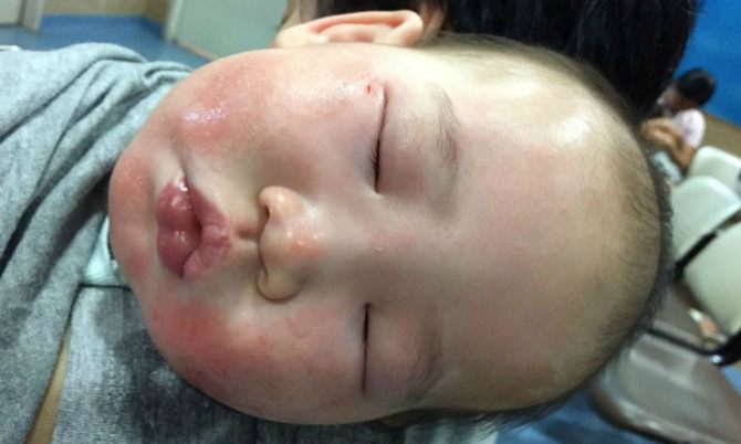 Bayi saya alami alergi susu formula yang mengancam nyawa - Parents perlu waspada!