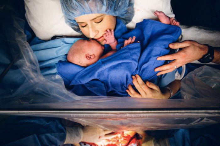 10 Foto Intim Melahirkan Cesar dan Kisah Luar Biasa Dibaliknya