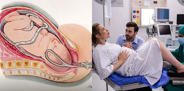 Melahirkan dengan Forceps, Kenali Langkah Pelaksanaannya hingga Risiko bagi Janin dan Ibu