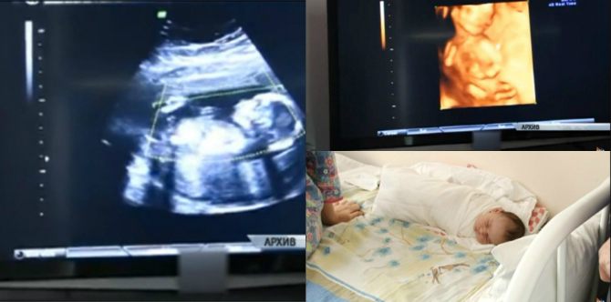 Langka, seorang ibu hamil di luar rahim lahirkan bayi sehat!