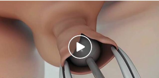 Parents, Tonton Video Sunat pada Bayi Laki-laki ini untuk Pengetahuan Anda