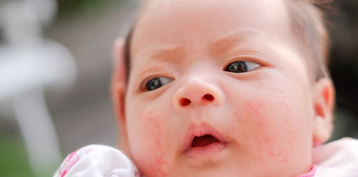 20 Jenis Ruam Kulit pada Bayi, Penyebab dan Cara Mengatasi