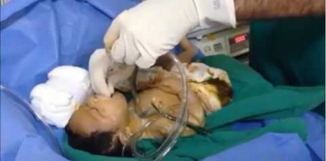 Bayi meninggal keracunan air ketuban, waspadai Sindrom Aspirasi Mekonium