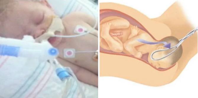 Bayi Olivia meninggal akibat tengkorak retak saat persalinan forceps