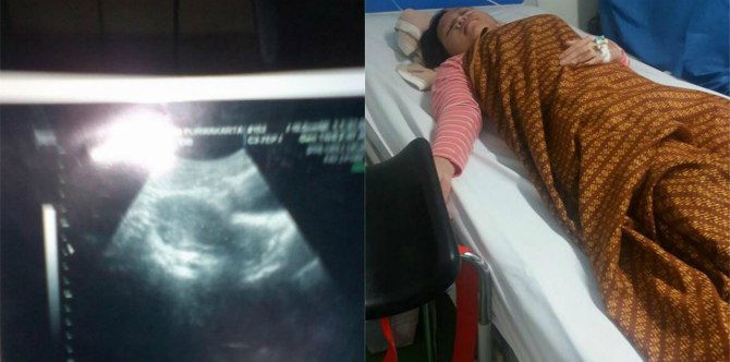 Darah Kotor 3 Tahun Terkumpul di Rahim setelah Jalani KB Suntik, Simak Kisah Ibu Ini