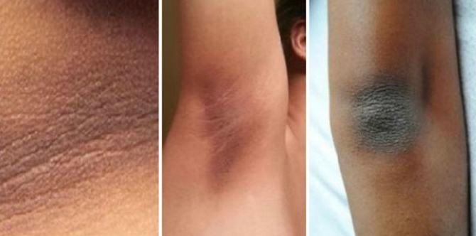 7 Bahan alami untuk cerahkan kulit ketiak, leher, siku, dan lutut