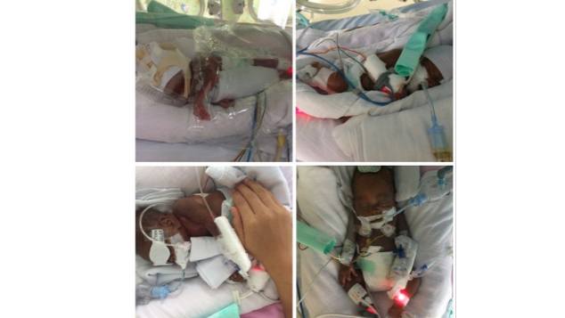 Perjuangan bayi Rasyiqul, yang lahir prematur di usia kandungan 5 bulan