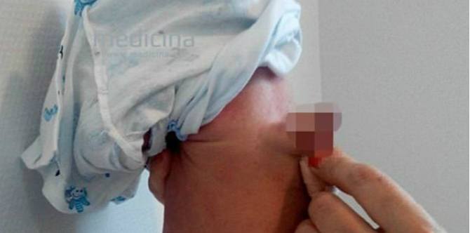 Bayi lahir dengan dua penis, yang satu tumbuh di bagian punggung bayi