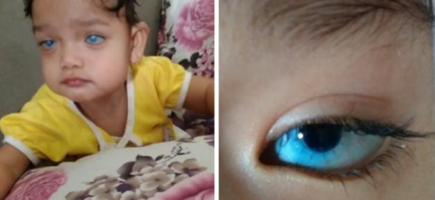 Syahnaz, balita 2 tahun butuh transplantasi mata karena ibu terinfeksi rubella saat hamil