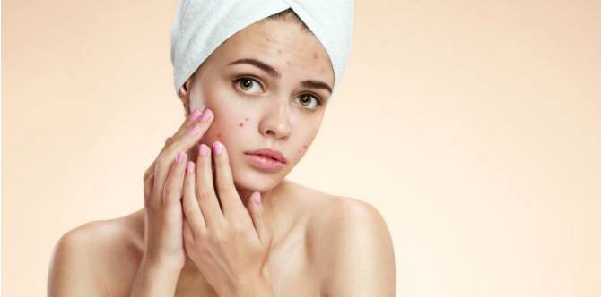 Cara Aman Mengatasi Jerawat Saat Hamil dan Obat yang Harus Dihindari