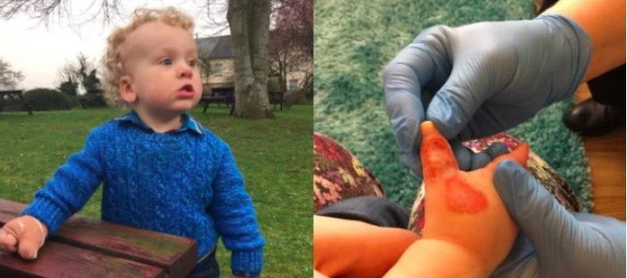 Peringatan seorang Ibu, anak terluka bakar akibat vacuum cleaner hanya dalam 5 detik!