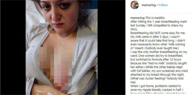 Ibu ini tunjukkan foto mastitis, bentuk perjuangannya dalam menyusui anak