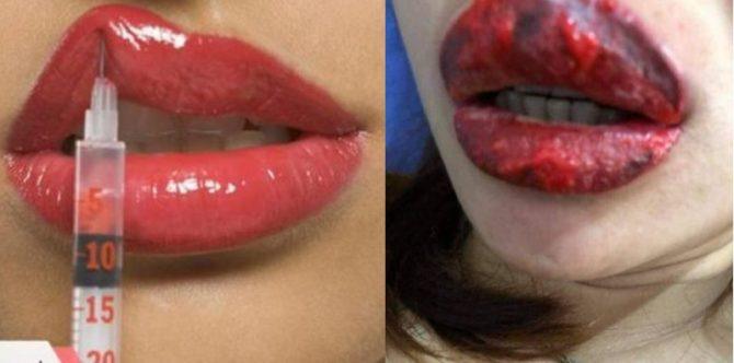Ngeri! Setelah melakukan tato bibir, bibir perempuan ini jadi luka parah