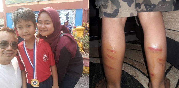 Kaki siswa dipukul guru dengan rotan hingga memar dan sobek, sang ayah ungkapkan kekecewaan