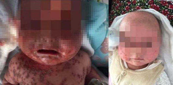 Bayi terinfeksi Herpes dari ibu yang sering mencium bibirnya, kenali tanda-tandanya!