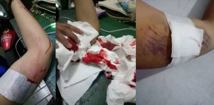 Terjadi lagi! Lepas KB implan, ibu ini alami pendarahan hingga tangan membengkak