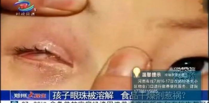 Mata anak ini meleleh dan buta permanen akibat silica gel, waspada Parents!