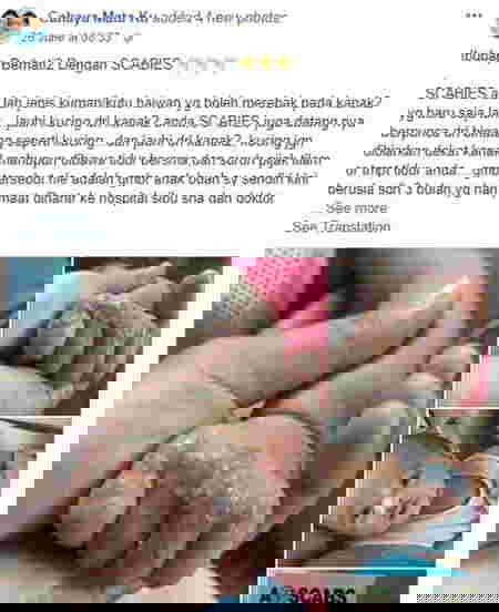 scabies pada anak 1