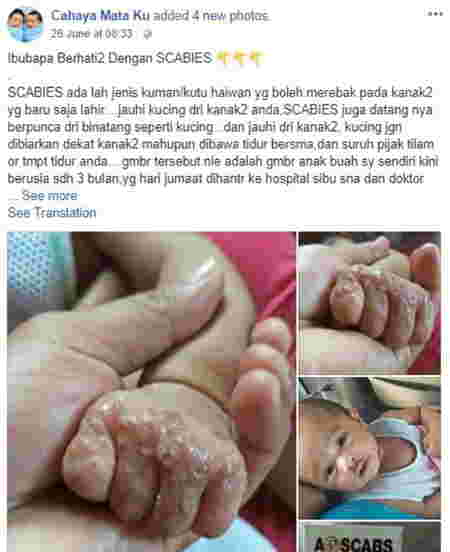 scabies pada anak 1