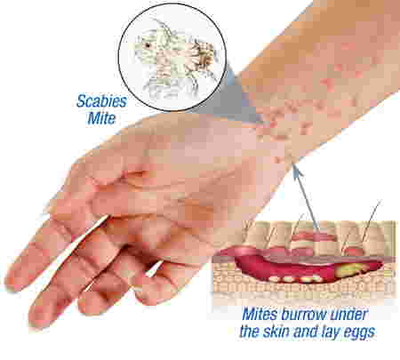 scabies pada anak 2