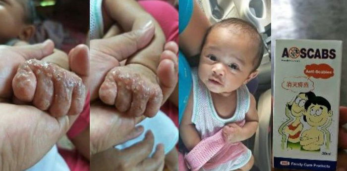 Kenali Penyebab dan Gejala Scabies pada Bayi, Waspadai Hal Ini!