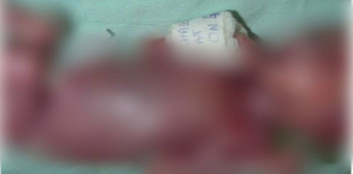 Bayi terlahir tanpa kulit lantaran ibu mengonsumsi obat keras saat hamil?