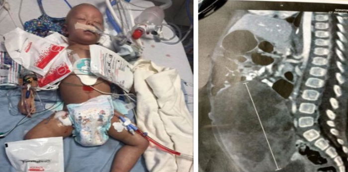 Kisah bocah 15 bulan yang mengalami kanker ovarium, ini curahan hati sang ibu