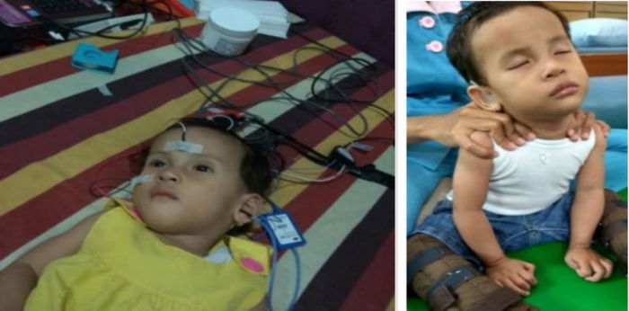 Anak terinfeksi virus TORCH, ibu ini ingatkan pentingnya vaksin MR