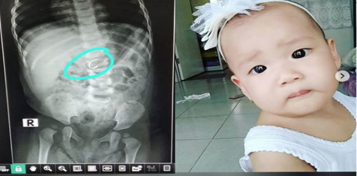 Anak tak sengaja menelan anting, ini pesan sang Bunda untuk semua orangtua