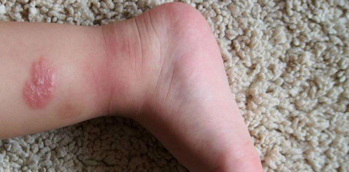 Begini cara efektif menghilangkan bekas luka pada kulit anak