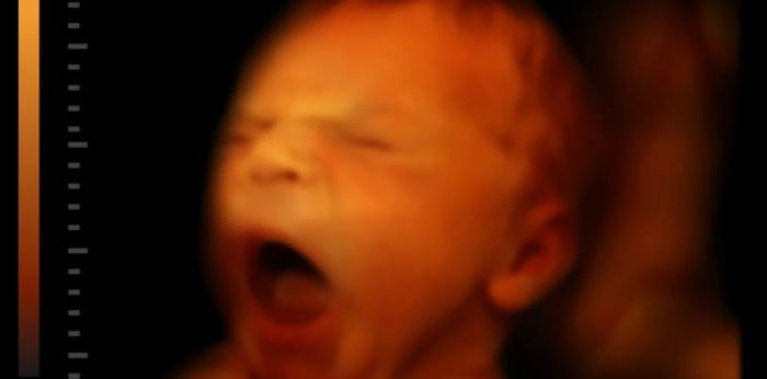 Fetal Alcohol Syndrome: Penyebab, Gejala, dan Pengobatan