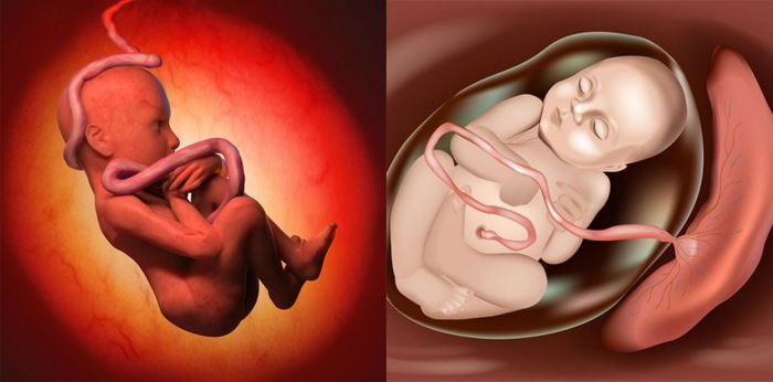 Penyebab Bayi Terlilit Tali Pusar dan Ciri-cirinya yang Perlu Diketahui