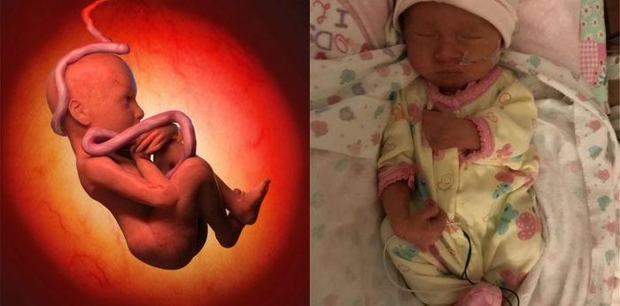 Terlilit tali pusar dalam kandungan, bayi ini selamat berkat ibunya
