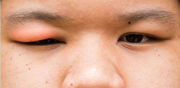 Tidak Nyaman karena Mata Bengkak? Kenali Penyebab, Cara Mengatasi, dan Obatnya